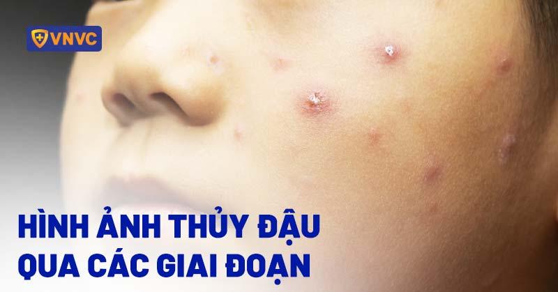 Hinh anh not ban thuy dau tren da, minh hoa trieu chung chinh trong benh an